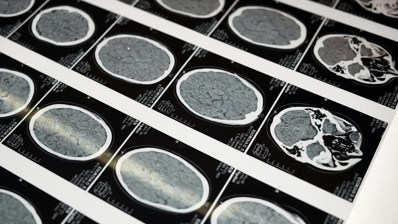 Tomografia do cérebro humano. — Foto: Pexels