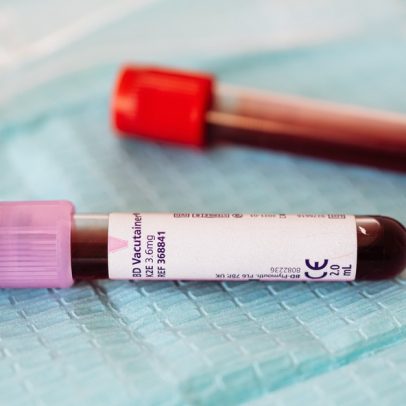 Alteração no sangue pode indicar depressão, aponta estudo