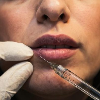 Alerta sobre excessos na beleza com síndrome da face hiperpreenchida