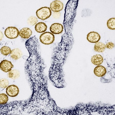 Hantavírus grave pode ter letalidade de até 80%, diz infectologista