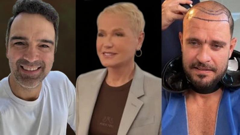 Tadeu Schmidt, Xuxa e Diogo Nogueira já fizeram transplante capilar
