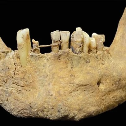 Homem consertou dente com fio de ouro 20 quilates há 500 anos