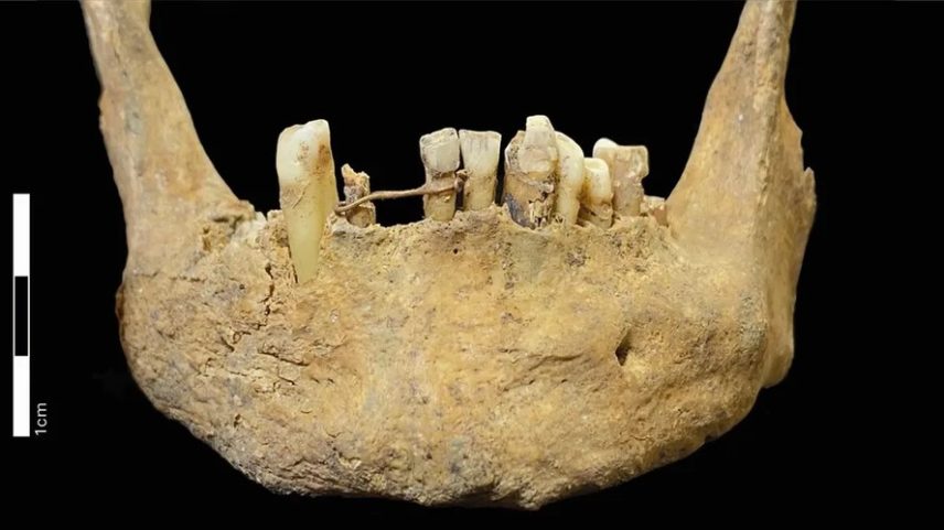 Apesar da ponte dentária feita com fio de ouro indicar que o homem provavelmente era rico, seus outros dentes apresentavam sinais de cáries, acúmulo de placa bacteriana e doença periodontal