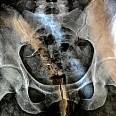 Mãe perde parte do intestino e útero após descobrir dois DIUs em SC