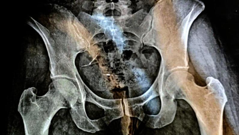 Lorenna viveu por meses com dois DIUs dentro do corpo — Foto: Arquivo pessoal