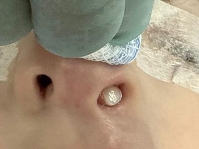 Dente nasce no nariz de criança no Paraná; condição muito rara