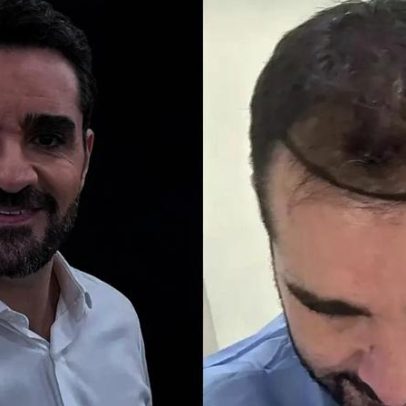 Marcelo Cosme da GloboNews mostra antes e depois de transplante capilar