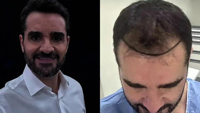 Jornalista fez uma retrospectiva do procedimento realizado há dois anos