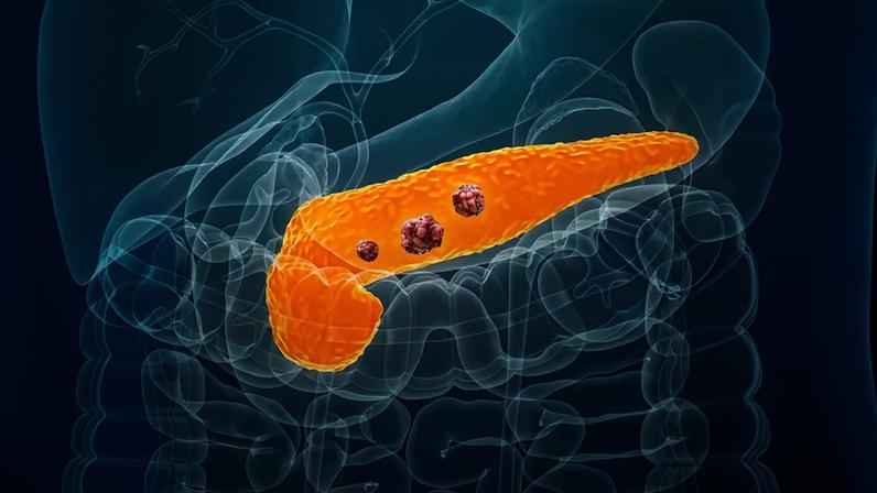 Ilustração médica 3D do pâncreas laranja com três tumores vermelhos, localizado no abdômen humano, com órgãos transparentes e veias azuis visíveis