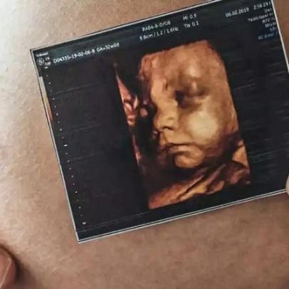 Ultrassonografia obstétrica avança no diagnóstico pré-natal
