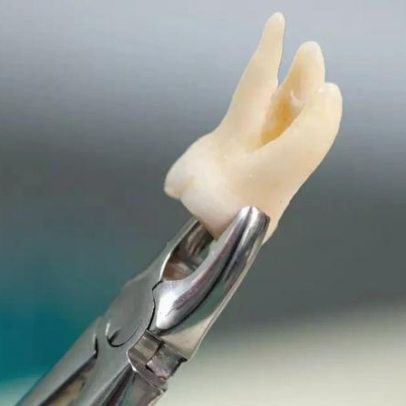 Dente do siso: por que aparece e quando é indicado extrair