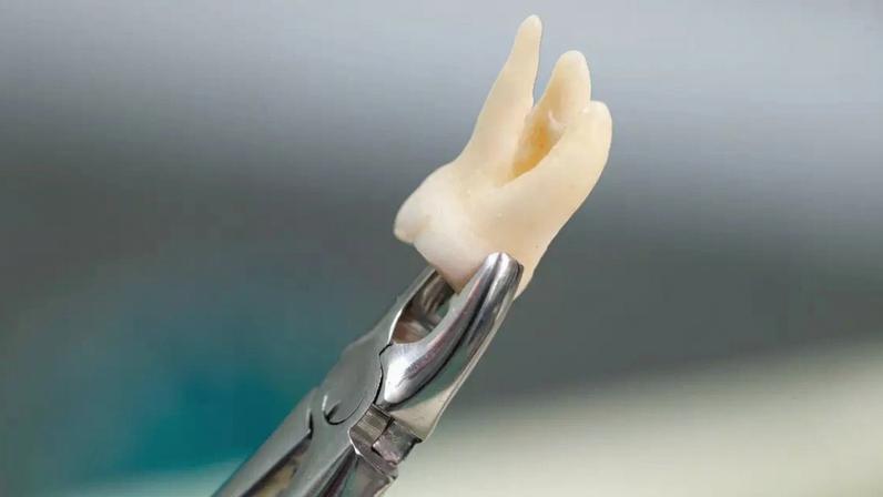 Dente do siso: por que aparece e quando é indicado extrair