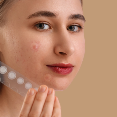 Adesivos para espinhas funcionam? Dermatologista explica