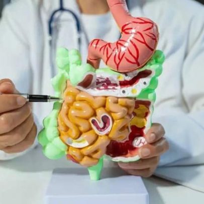 Intestino permeável vs intestino irritável: principais diferenças