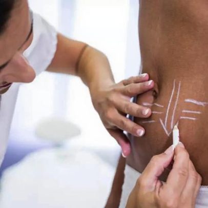 Lipo HD amplia opções de definição corporal