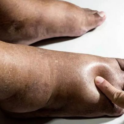 Diabetes pode mostrar sinais na pele, olhos e pés; saiba quais