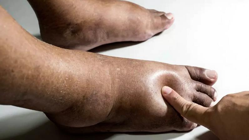 Confira quais os sinais que o diabetes da no corpo