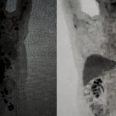 9 em 10 linfoma não-Hodgkin reduzem com terapia da USP, aponta estudo