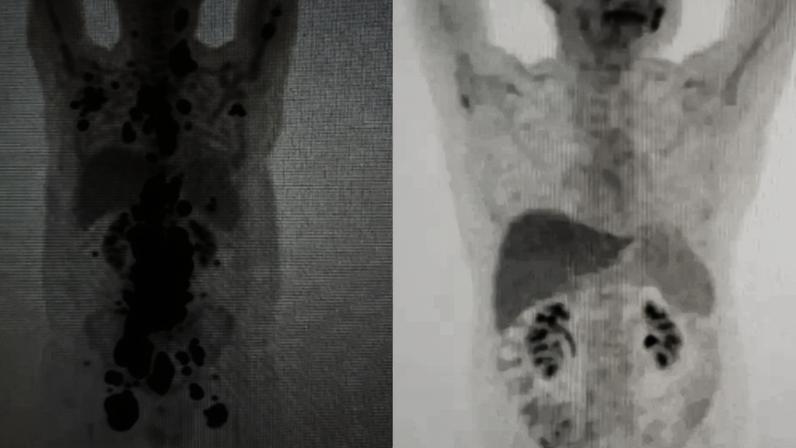 Exames mostram antes e depois de câncer de paciente; à direita, imagem mostra remissão da doença — Foto: Arquivo pessoal