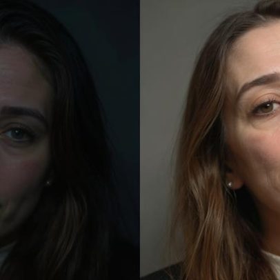 Maíra Cardi revela deformações no rosto e risco de paralisia após procedimento