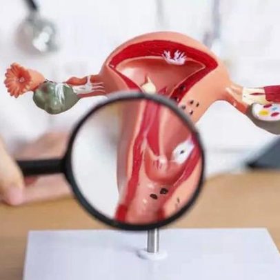 Nem todo mioma exige cirurgia; especialista recomenda somente acompanhamento