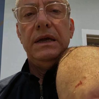 Âncora da Globo leva 4 pontos após ataque de pitbull sem guia