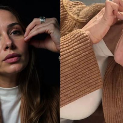 Maíra Cardi expõe sequelas de PMMA no rosto