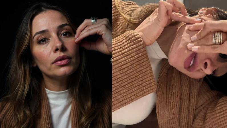 Maíra Cardi mostra complicações de PMMA injetado no rosto