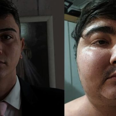 Adolescente ganha 40 kg em 6 meses devido a tumor de menos de 1 cm