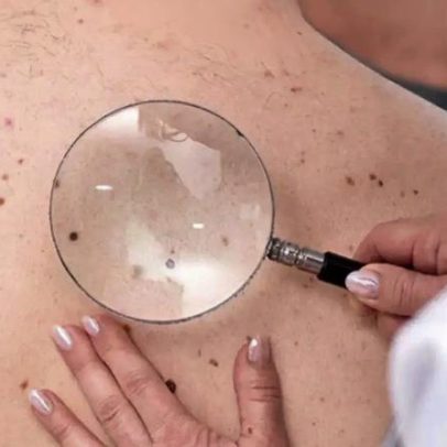 Sinais simples do câncer de pele podem indicar alerta