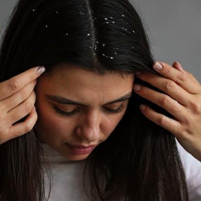 Frio aumenta a caspa: aprenda como interromper o ciclo