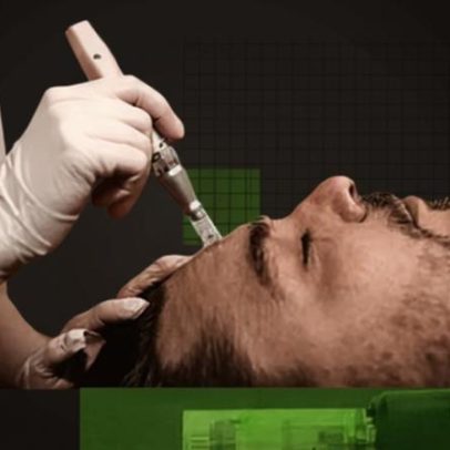 Microneedling: eficácia incerta e necessidade de mais evidências