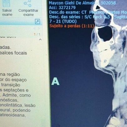 Cirurgia de remoção de tumor no pescoço: corrida contra o tempo