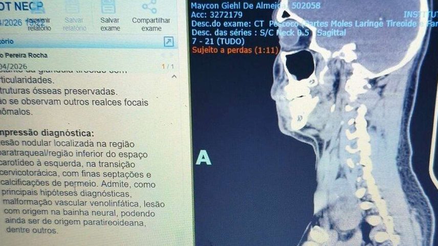 Cirurgia remoção de tumor no pescoço: a corrida contra o tempo