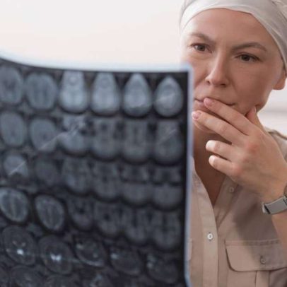 IA reduz diagnóstico de câncer cerebral de 12 dias para 12 minutos