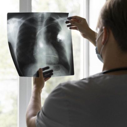 Mutação genética dificulta tratamento de câncer de pulmão, aponta estudo