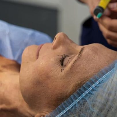 Procedimentos estéticos menos invasivos no rejuvenescimento