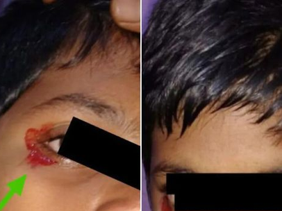Menino de 11 anos apresenta lágrimas de sangue; motivo preocupa médicos
