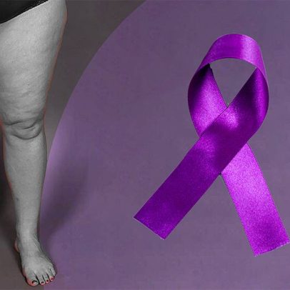 Lipedema afeta até 12% de mulheres no Brasil e é confundido com obesidade