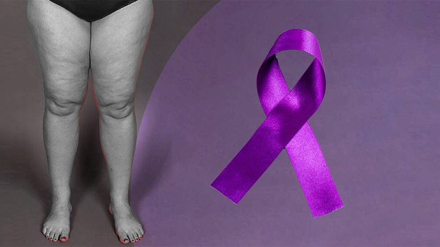 O lipedema é uma alteração crônica progressiva, ela é caracterizada por um acúmulo desproporcional de gordura na região de quadris, coxas e pernas Foto: Borgardottir/Wikimedia, Bjcomp/Magnific