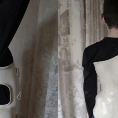 SUS Gaúcho usa tecnologia 3D e reduz cirurgias de escoliose