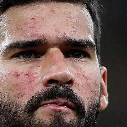 Alisson tem doença crônica que afeta pele; médico cita protetor solar