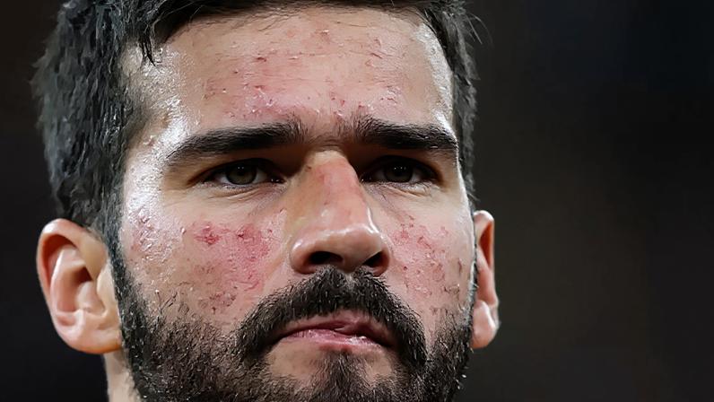 O que é a vermelhidão no rosto de Alisson Becker, o goleiro do Brasil na Copa 2026? Doença crônica não tem cura, aponta médica especialista - na foto, jogador durante a Copa 2018.