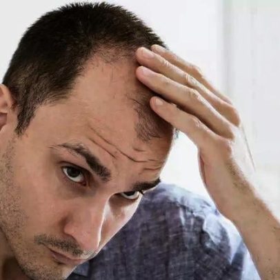 Minoxidil: como funciona e dúvidas sobre impotência