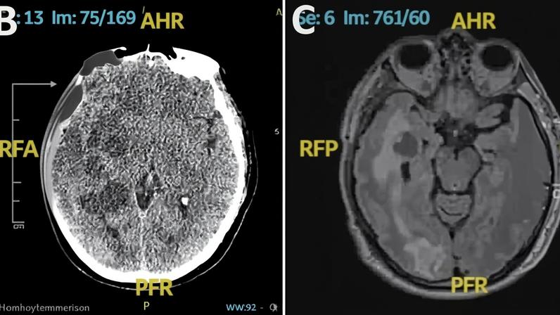 Radiografia do cérebro de homem espanhol com suposta suspeita de câncer. Ele foi diagnosticado com neurocesticercose