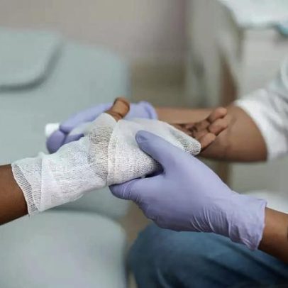 Casos de queimaduras sobem 16% no Brasil, saiba como agir