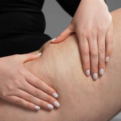 Celulite não desaparece apenas com dieta e exercícios; entenda os fatores