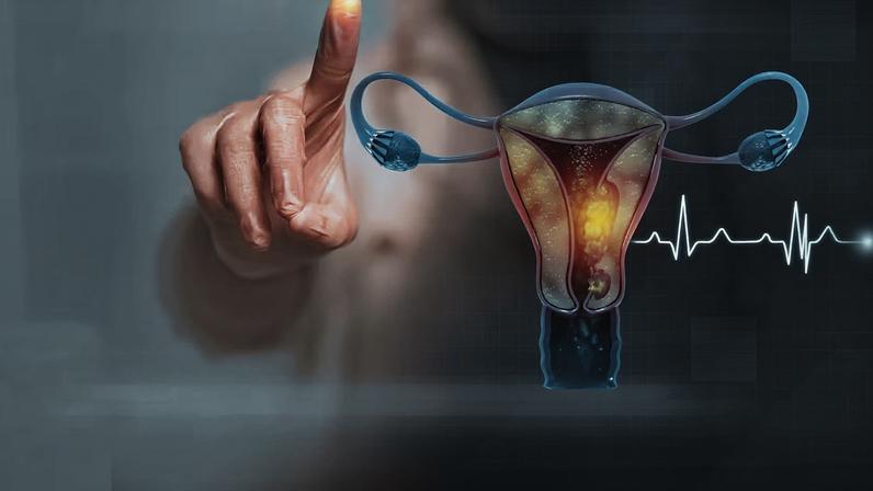 Dados atualizados destacam avanços importantes em tumores ginecológicos e reforçam o papel da imunoterapia no tratamento do câncer de endométrio avançado