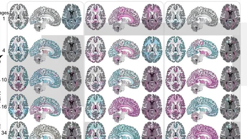 A esclerose múltipla é uma doença que ocorre quando o próprio sistema imunológico passa a atacar a mielina, estrutura responsável por proteger os neurônios e garantir a transmissão adequada dos impulsos nervosos