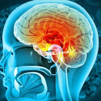 Meningite: principais sintomas e formas de prevenção